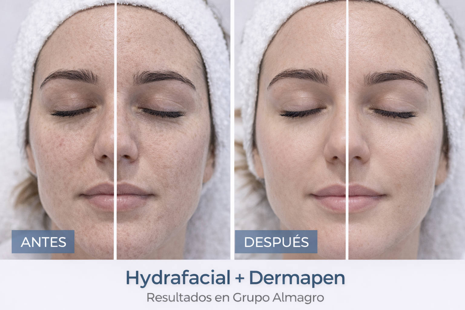 Dermapen en Málaga con estética avanzada y tratamiento profesional en Grupo Almagro